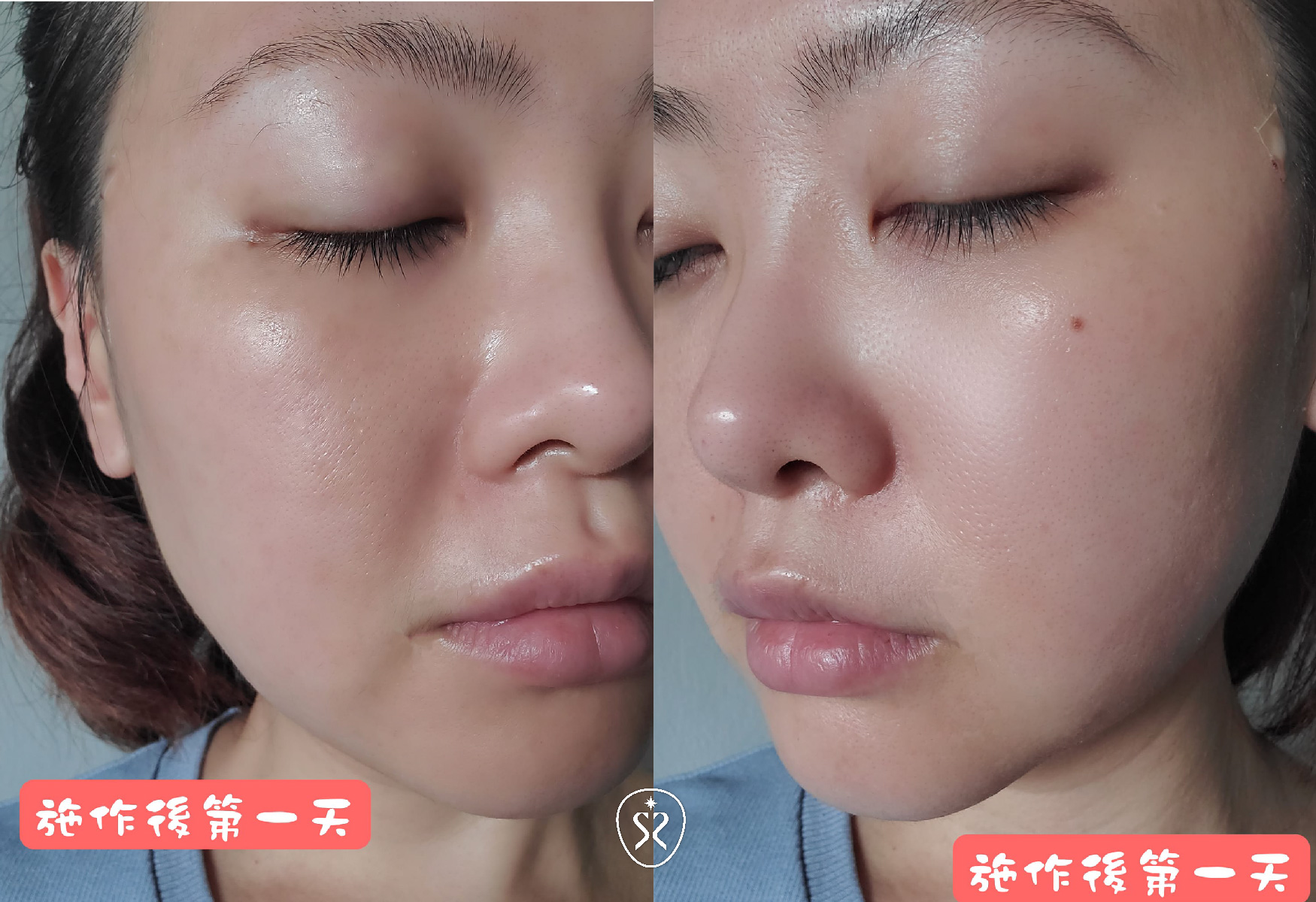 埋線拉提術後會有稍微腫脹的修復期，大約2~3月後的效果會更佳